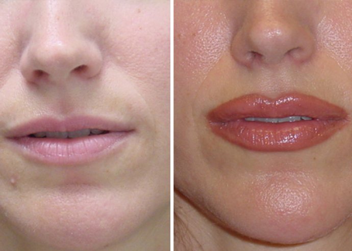 Татуаж или увеличение губ. Хейлопластика Корнер лифт. Перманентный макияж губ. Перманентный макияж губ до и после. Перманент губ до и после.