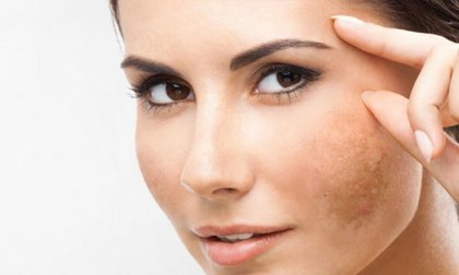 Pigmentfolt-halványító kollagén indukciós terápia mikrotűs mezopennel és orvosi tisztaságú Radiance szérummal