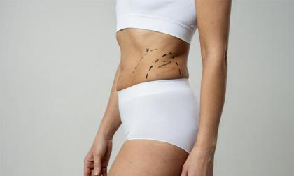 Monosculpt rádiófrekvenciás zsírbontás az Angyali Érintés Szépségszalonban